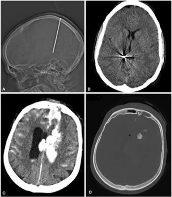 Surviving the Scene in Civilian Penetrating Brain Injury: Injury Type, Cause and Outcome in a Consecutive Patient Series in Austria